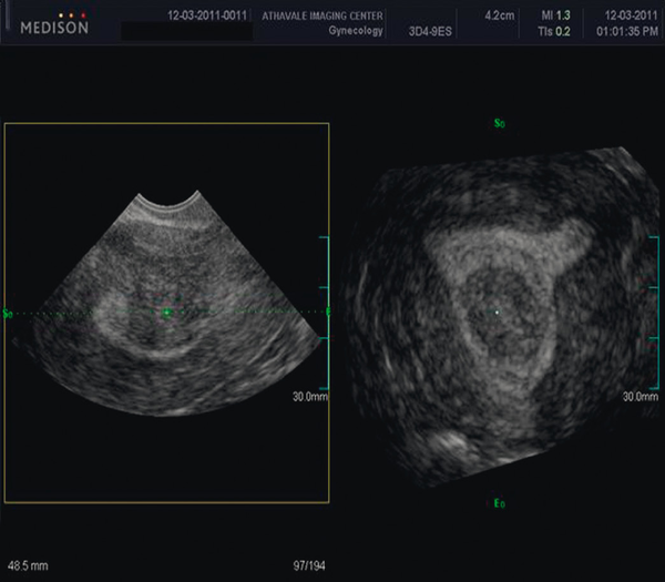 UterineFibroids